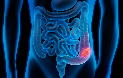 Herts Local Section: Bowel Cancer – a tale of mutants and robots, by Rory Harvey of Bedford Hospital